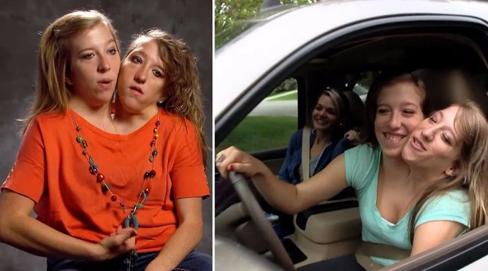 最诡异的双头连体人，两个大脑如何控制同一个身躯？