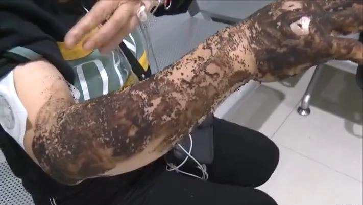 重庆女子江边散步被蛇咬伤肿胀如馒头，在江边散步需要注意什么？