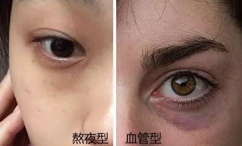 南京一医院开黑眼圈门诊，这个门诊的病人多吗？