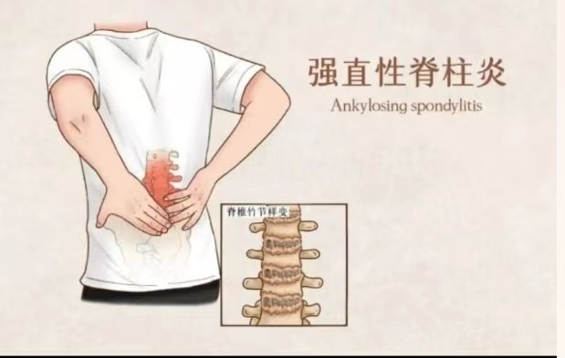 李宇春回应患强直性脊柱炎,这种病能不能彻底治愈?
